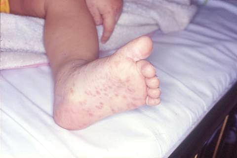 腸病毒症狀會在口腔、手掌、腳掌、肛門附近、膝蓋等處出現小水泡或潰瘍。